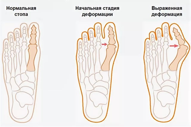 Чего следует избегать при поперечном плоскостопии стопы