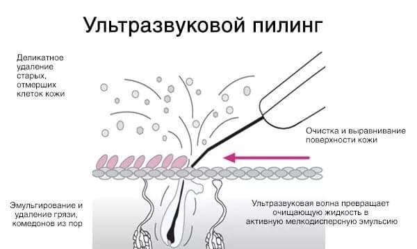 Ультразвуковой пилинг_УП_схема