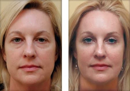 blepharoplasty.multilevelfatgrafting4-e1417371858744.jpg