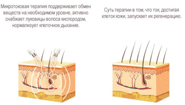 Процедура микротоки