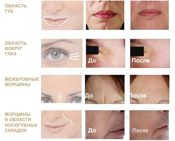 Процедура микротоки_технология