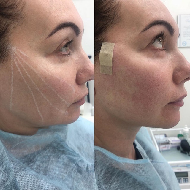 Как проходит армирование нитями Aptos Visage