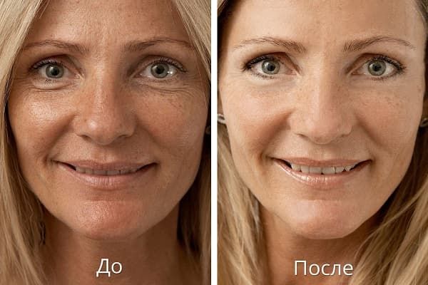 Фракционная мезотерапия кожи лица_эффективность