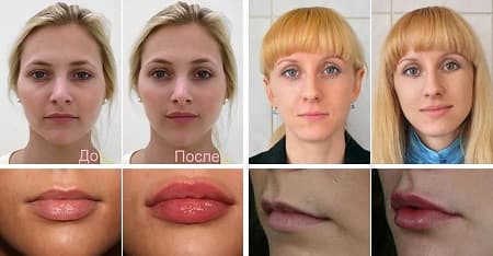 Пластика