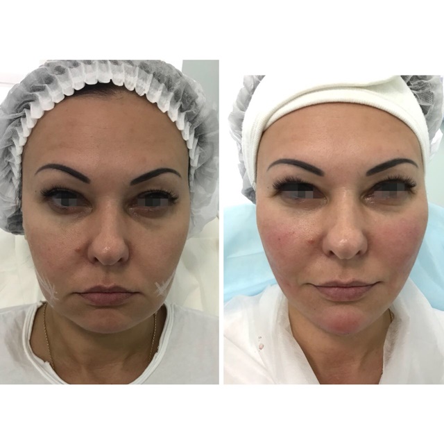 Кому показано применение нитей Aptos Visage